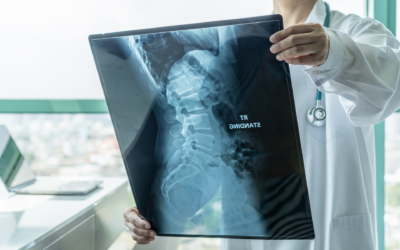 Litigating Spinal Cord Injury Cases